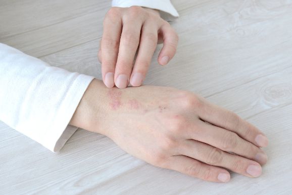 アトピー性皮膚炎のイメージ