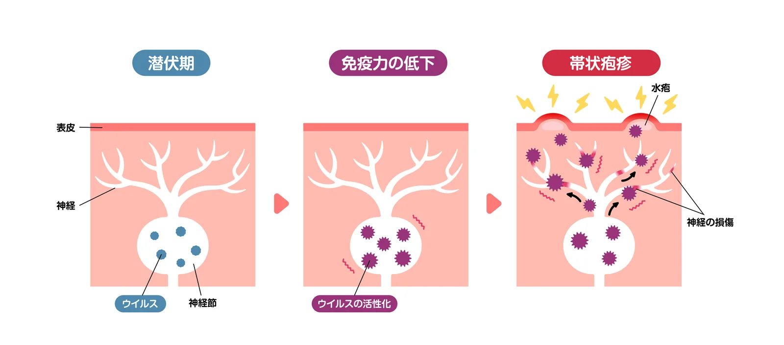 帯状疱疹の発症の仕組み(潜伏期・免疫力の低下・発症)を示す図